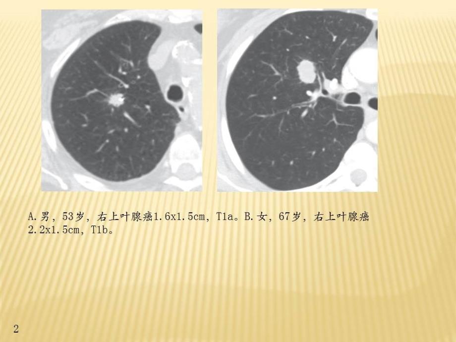 肺癌tnm分期图解_第2页