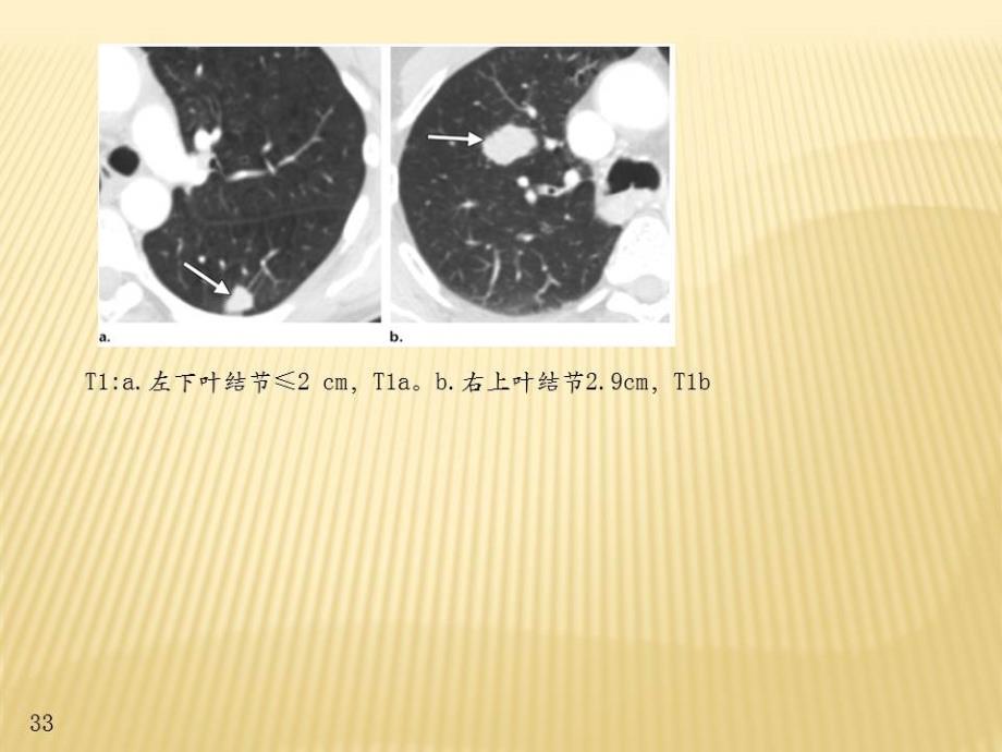 肺癌tnm分期图解_第4页