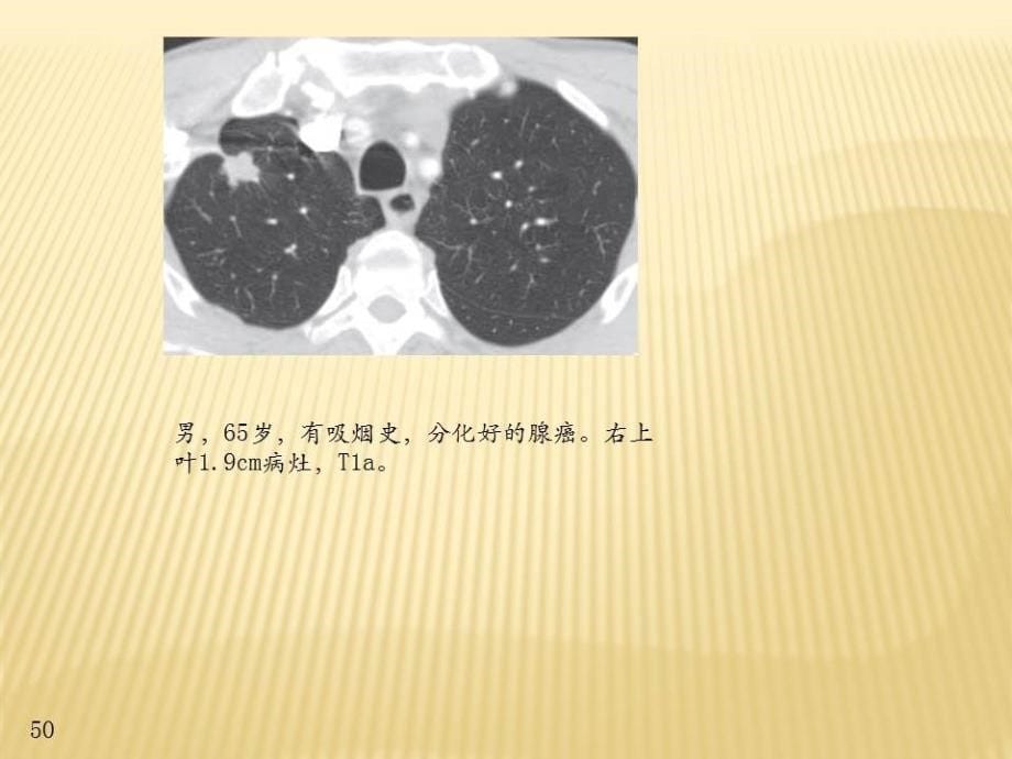 肺癌tnm分期图解_第5页