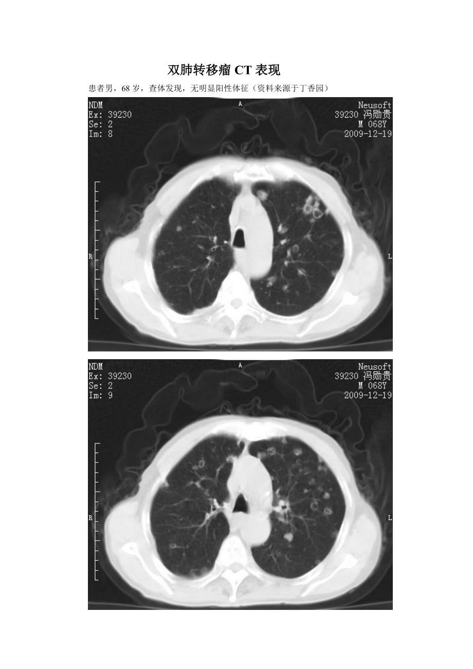 双肺转移瘤ct表现_第1页