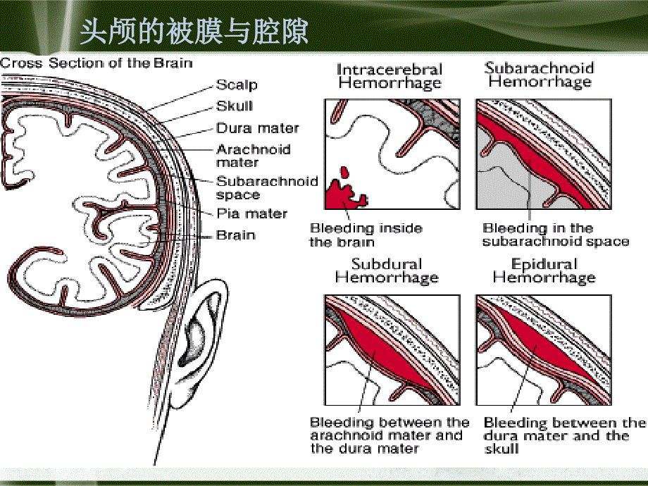 硬膜外血肿_第3页