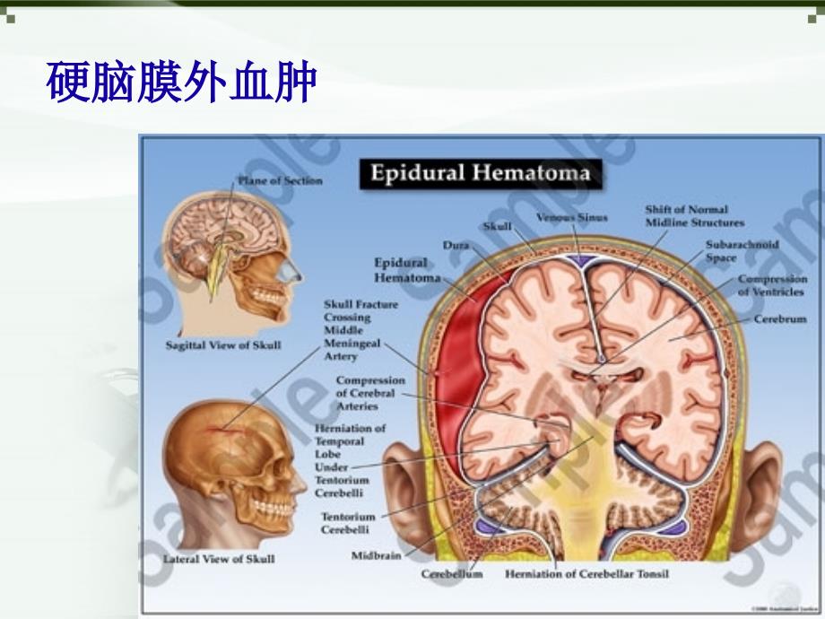 硬膜外血肿_第4页