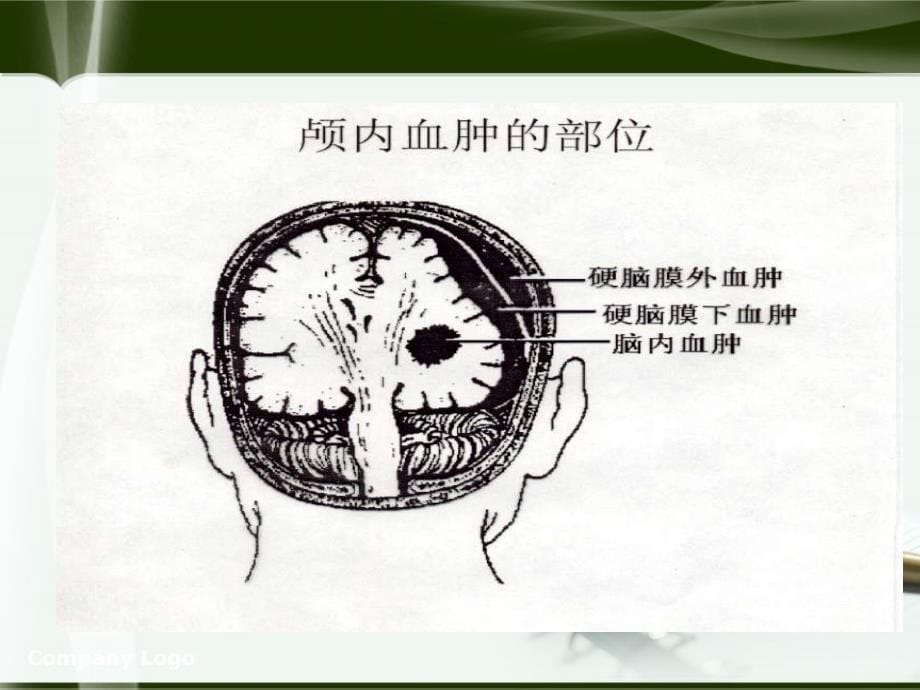 硬膜外血肿_第5页