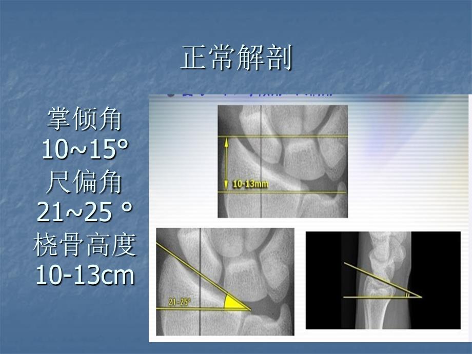 桡骨远端骨折应用锁定钢板手术方法_第3页