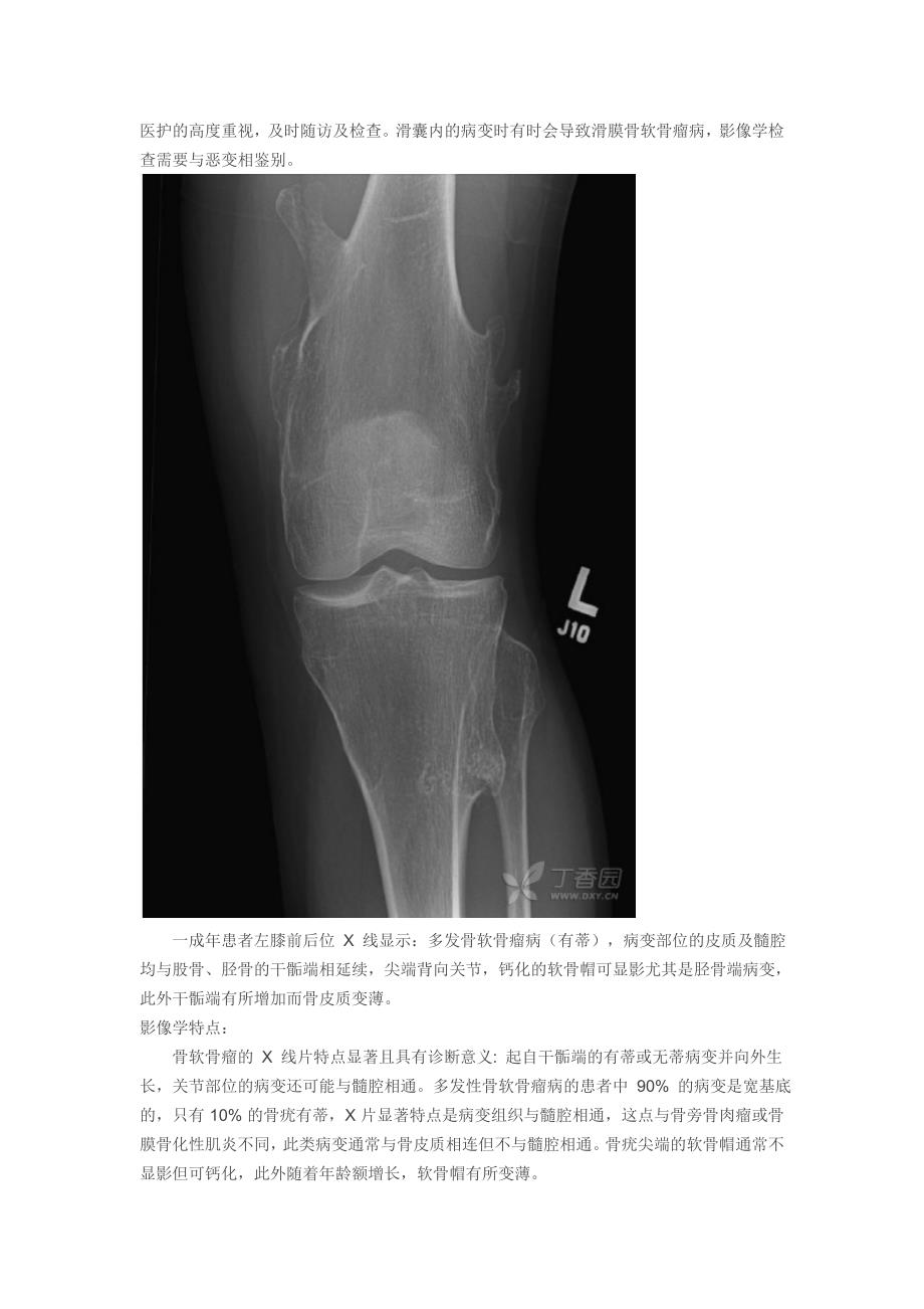 综述：遗传性单发或多发性骨软骨瘤_第2页