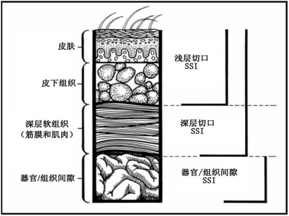 手术室医院感染预防与管理_第3页