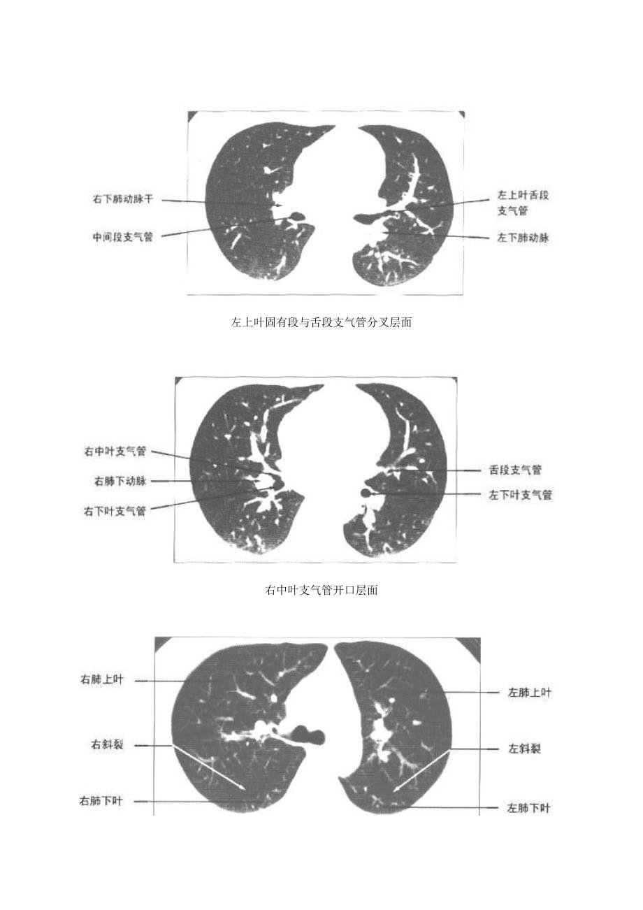 正常胸部纵隔窗ct解剖_第3页