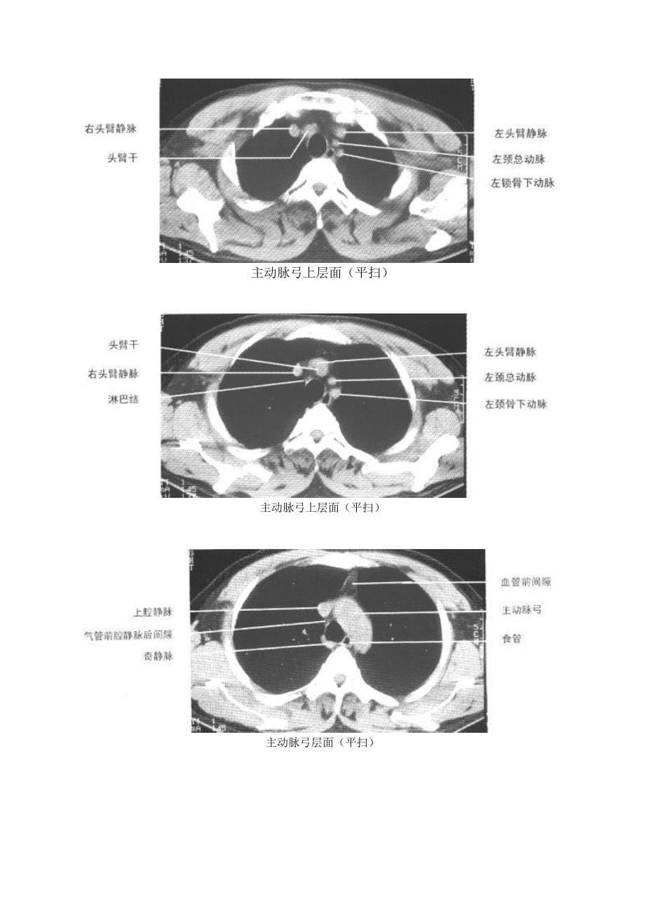 正常胸部纵隔窗ct解剖_第5页