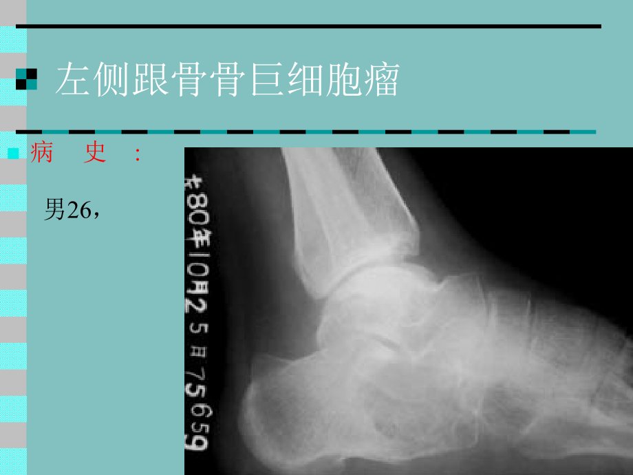 骨肿瘤X线病例图谱ONE_第3页