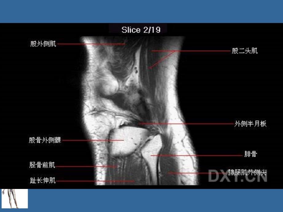 膝关节正常MRI解剖图谱_第4页