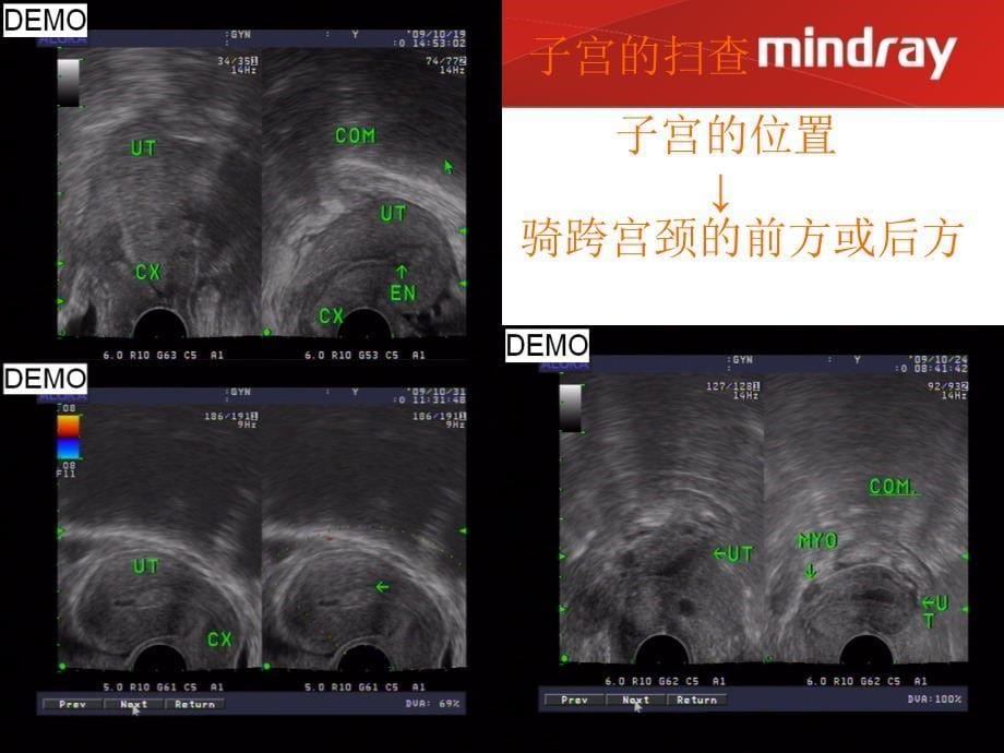 经阴道超声检查在妇产科疾病中的心得体会_第5页