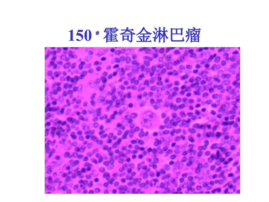 病理学1淋巴造血系统疾病_第4页