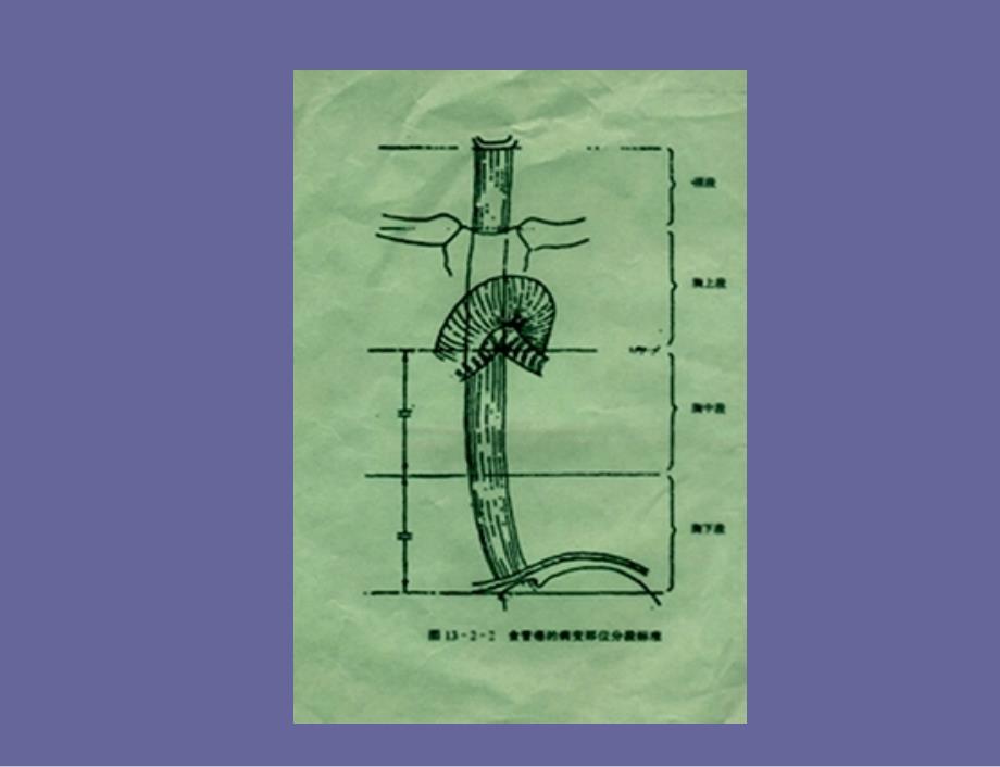 食管癌和贲门癌_第5页