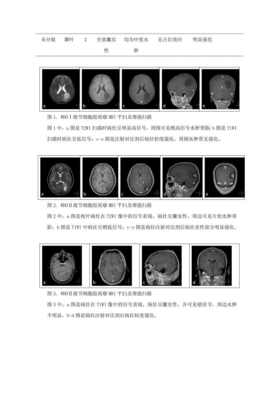 颅内节细胞胶质瘤MRI诊断与病理对照.doc_第5页