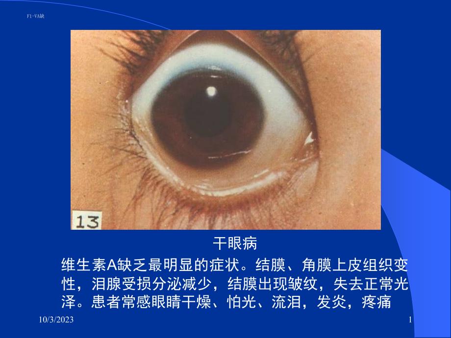 干眼病维生素a缺乏最明显的症状。结膜、角膜上皮组织变_第1页