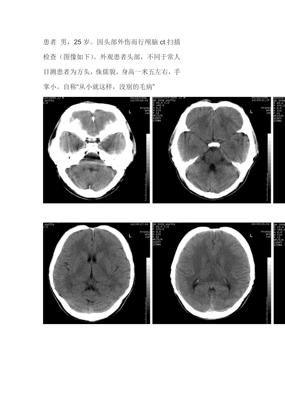 颅骨锁骨发育不全_第1页
