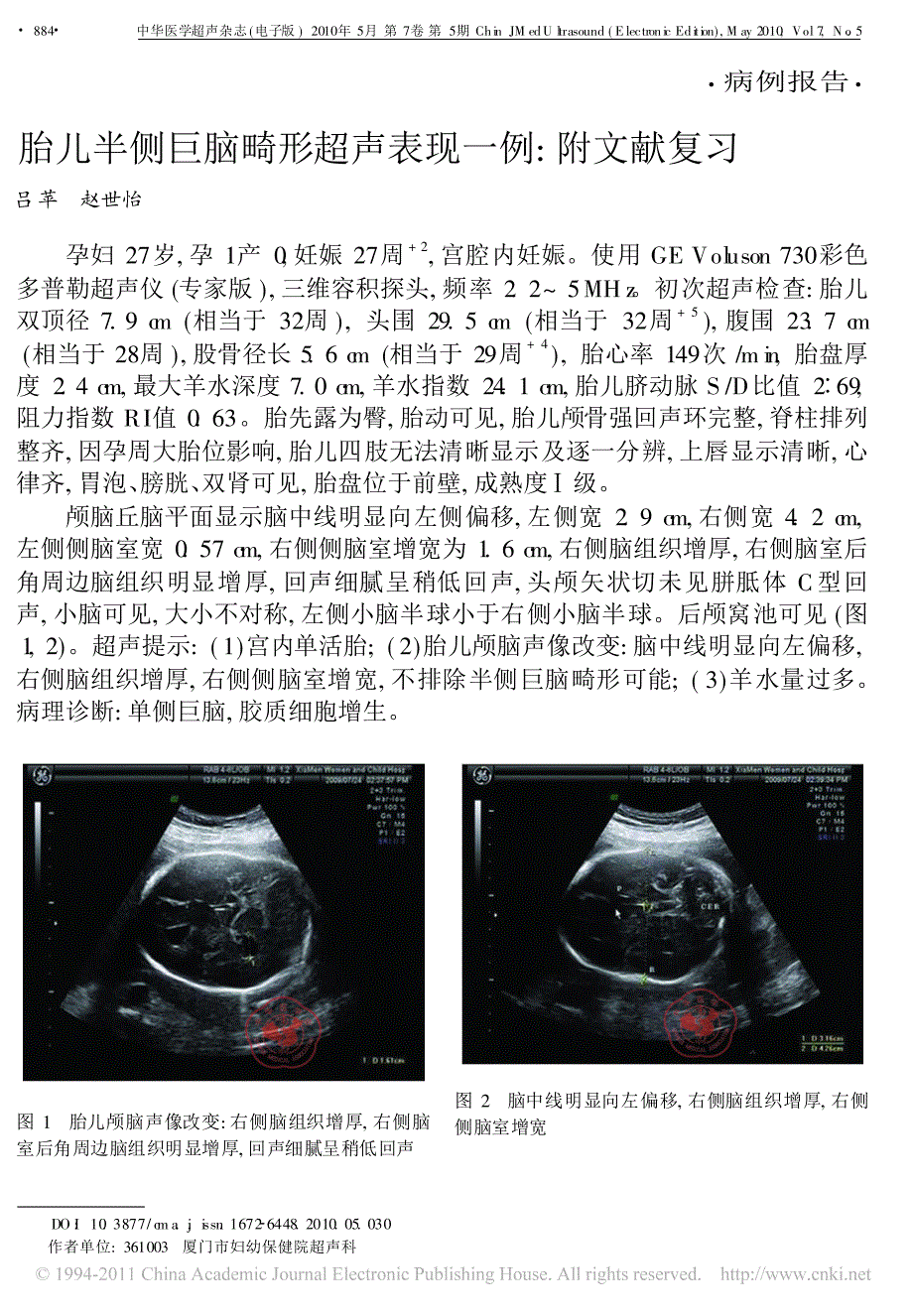 胎儿半侧巨脑畸形超声表现一例_附文献复习_第1页