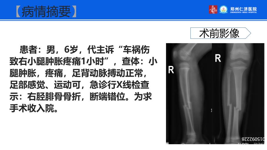 小儿胫骨骨折外固定治疗_第2页