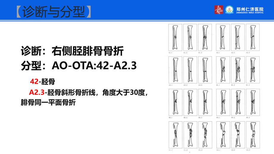 小儿胫骨骨折外固定治疗_第3页