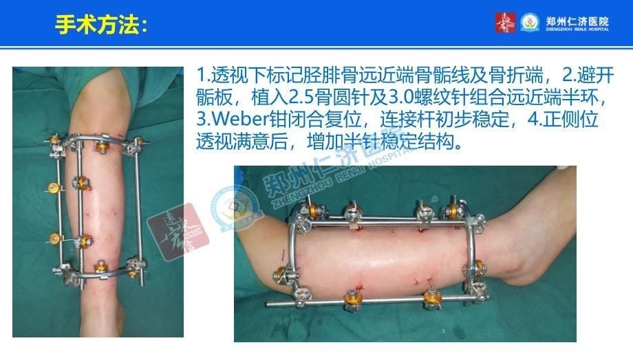 小儿胫骨骨折外固定治疗_第5页