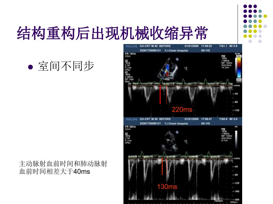 crt逆转心衰患者的电重构和结构重构_第4页