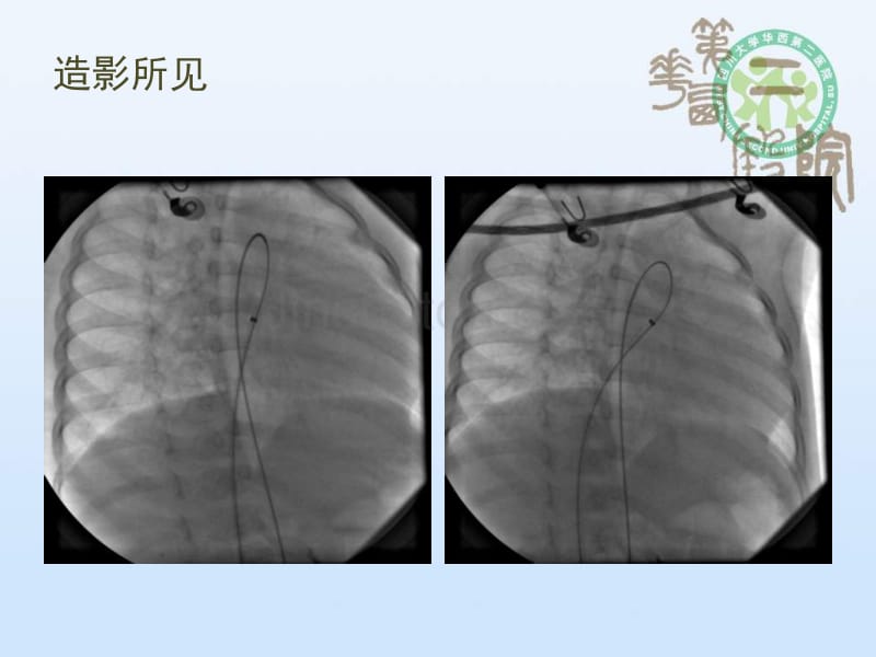 冠状动脉瘘介入治疗_第4页