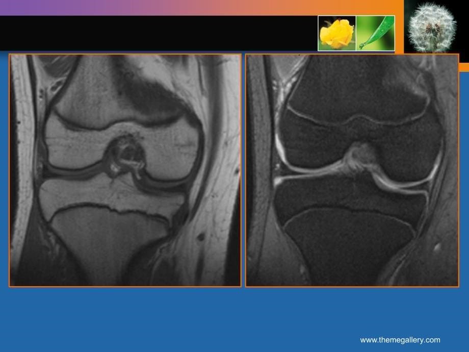 膝关节损伤MRI诊断_第5页