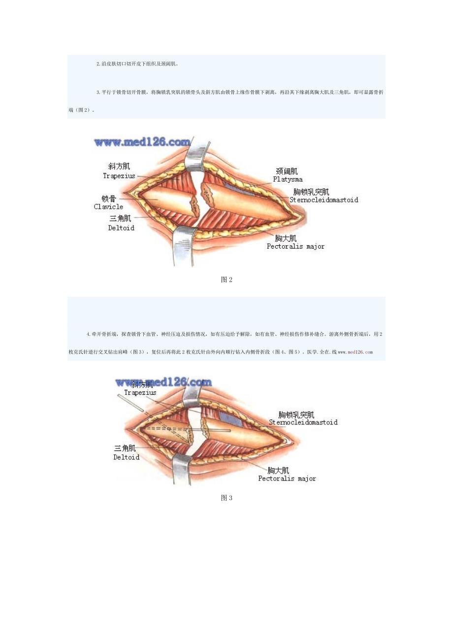 锁骨骨折的治疗手术切开复位内固定术_第2页