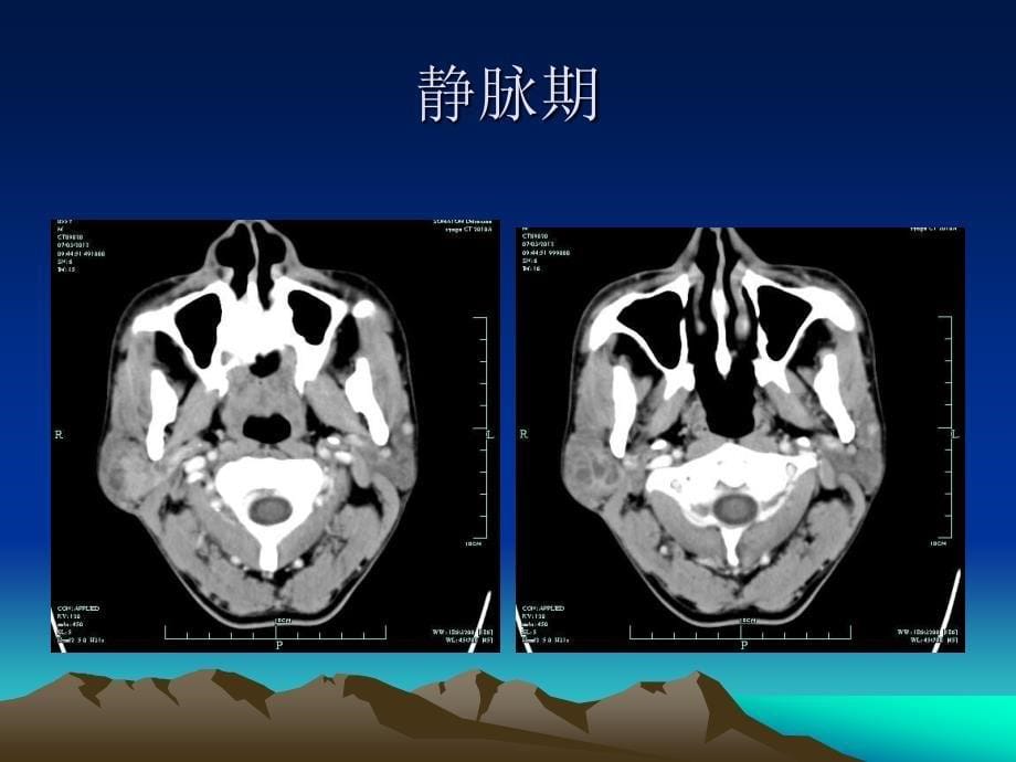 读片会-腮腺腺淋巴瘤_第5页