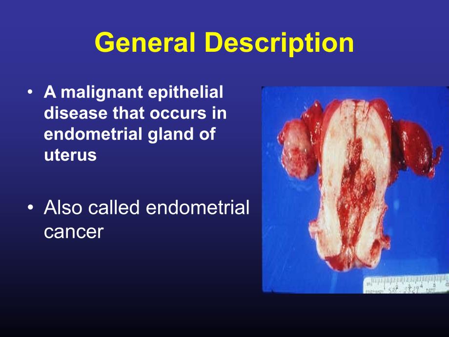 子宫癌（Uterine Cancer）-妇科八年制教学课件_第3页