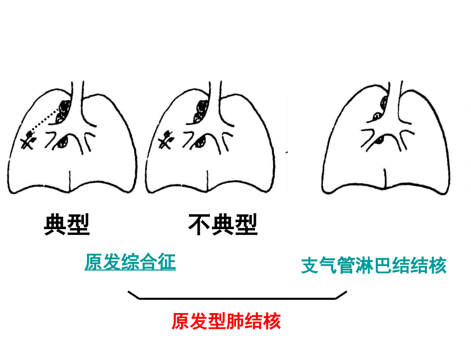 儿科学课件原发型肺结核_第4页