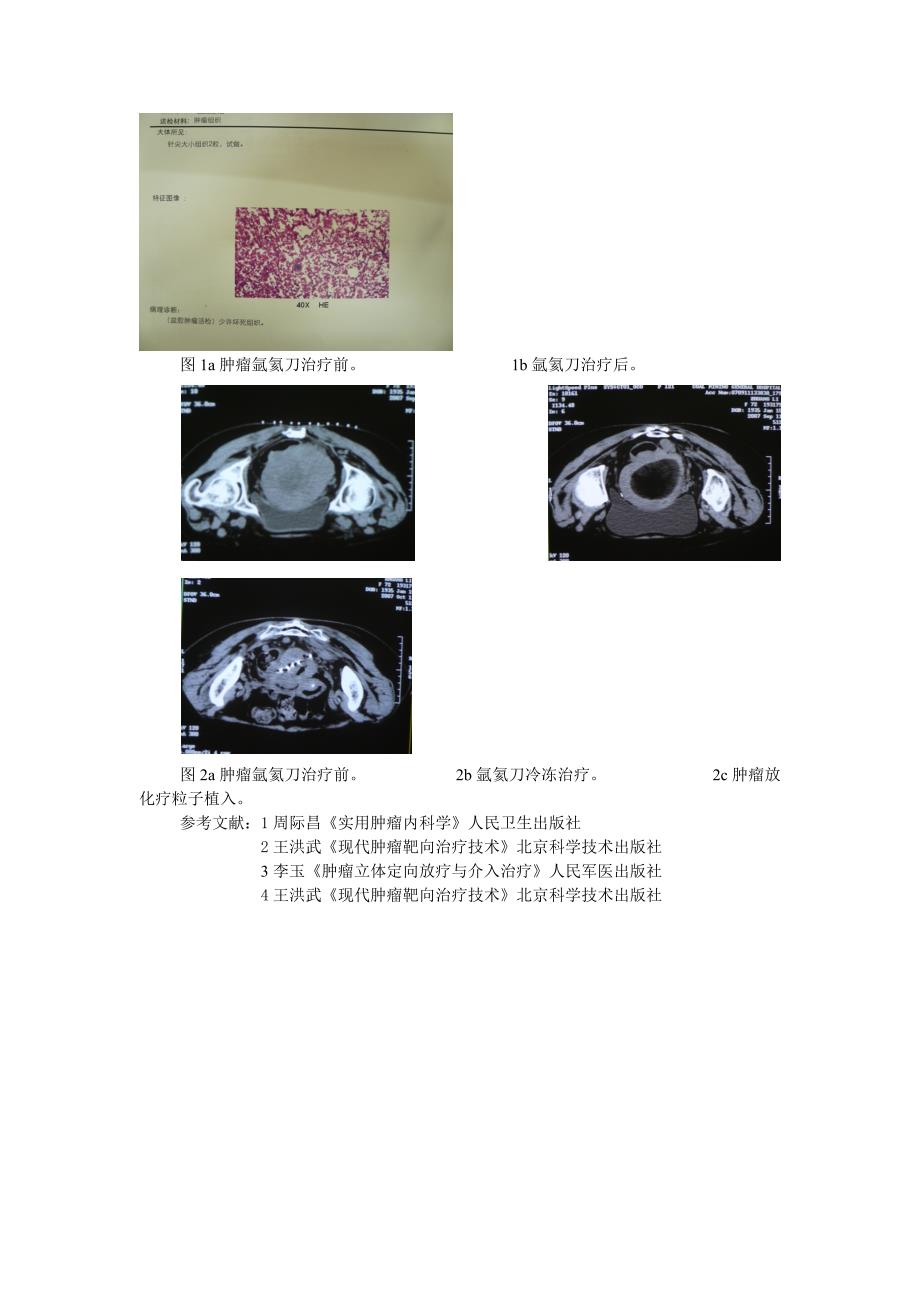 氩氦刀靶向冷冻结合放化疗粒子植入治疗老年盆腔巨大恶性肿瘤 罗凌飞_第3页