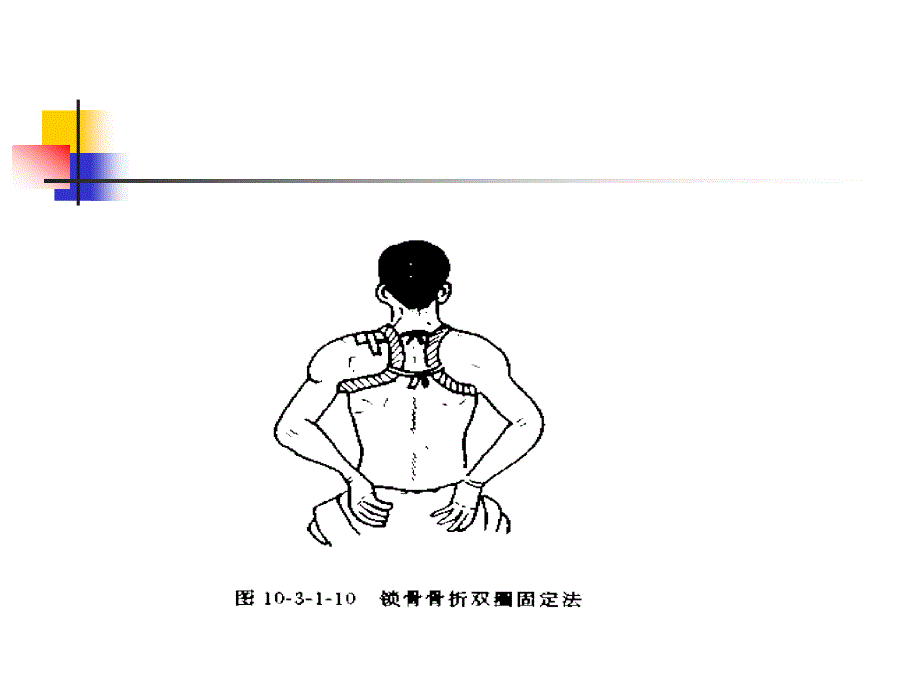 骨折急救固定法_第3页