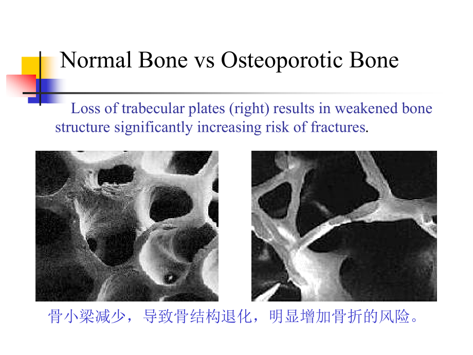 5-3老年骨质疏松症08143幻灯片_第4页