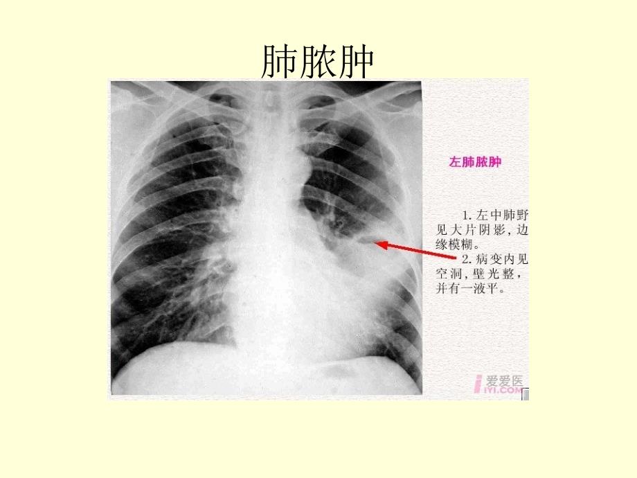 呼吸系统疾病典型幻灯片_第2页