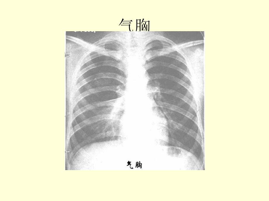 呼吸系统疾病典型幻灯片_第3页