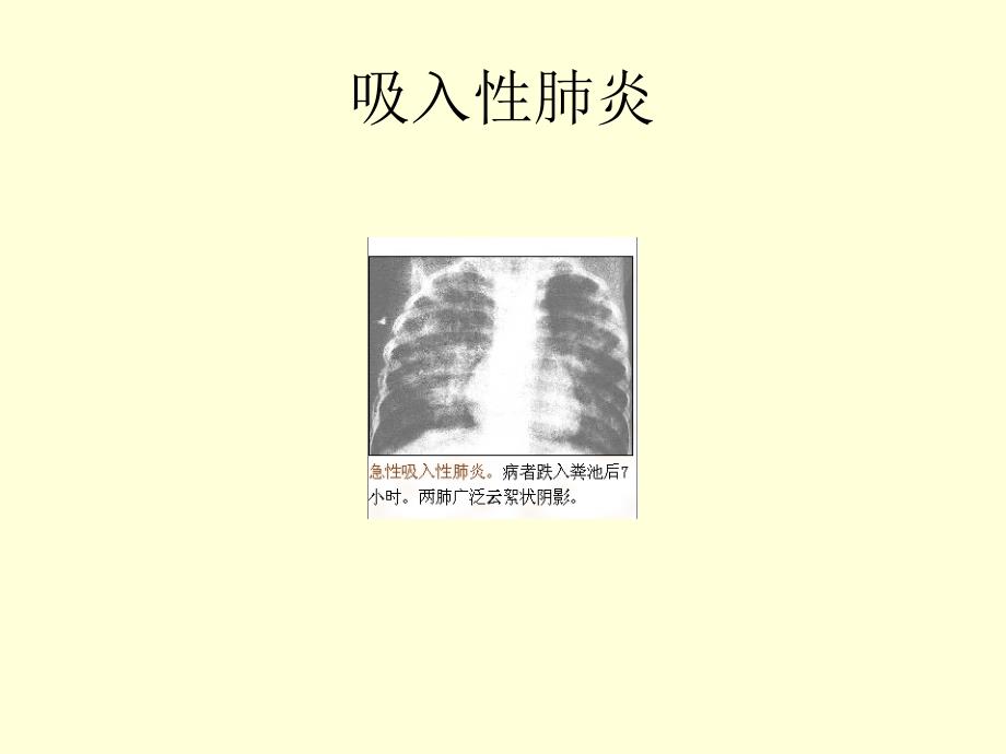 呼吸系统疾病典型幻灯片_第5页