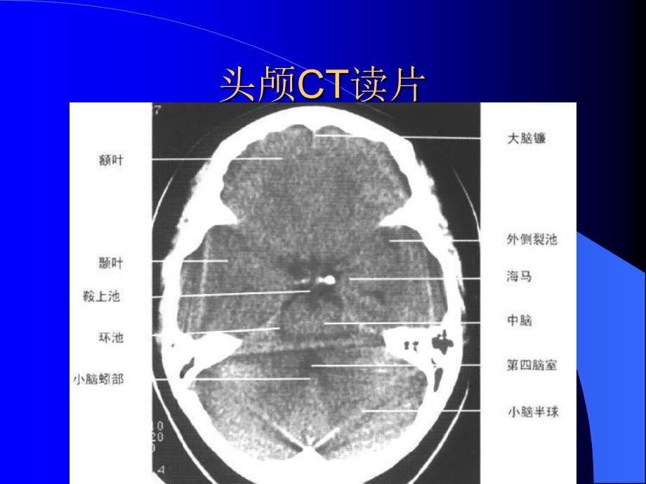 头颅CT读片_第3页