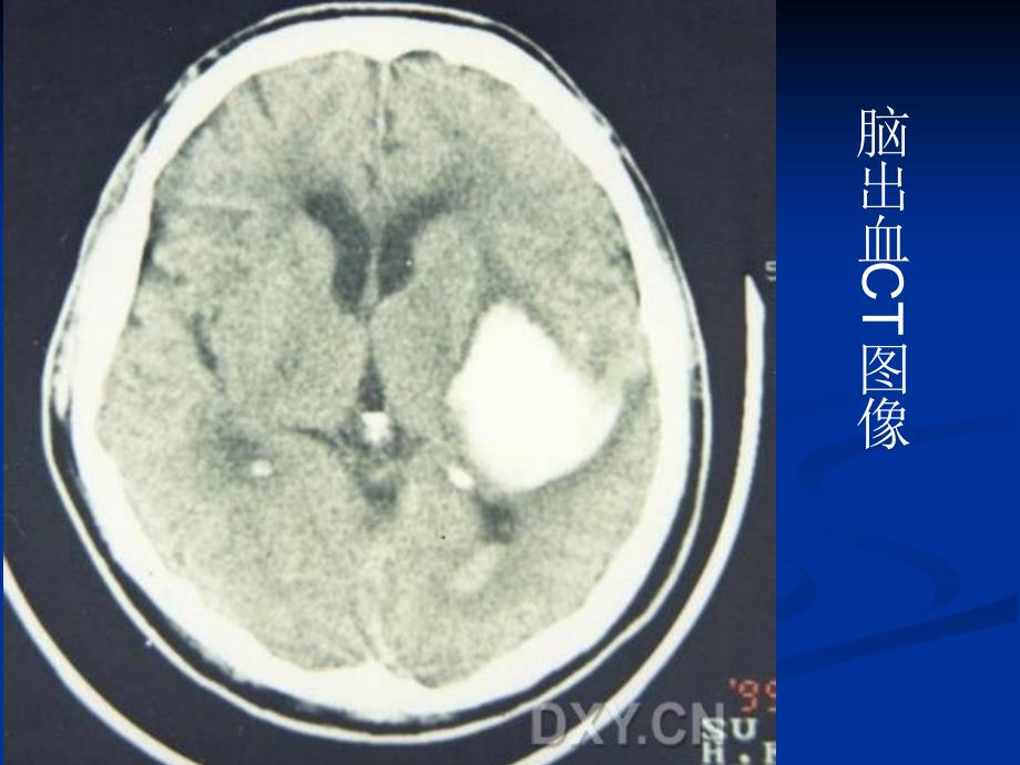 急性脑血管病的血压管理幻灯片_第4页