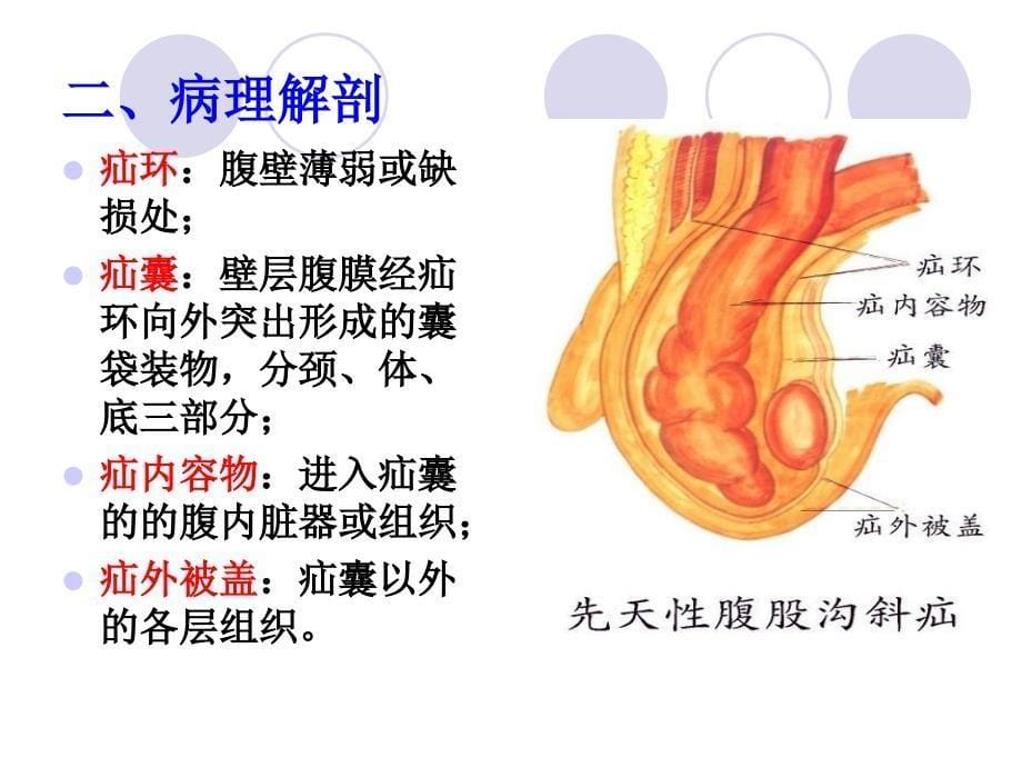 腹外疝病人的护理26幻灯片_第5页