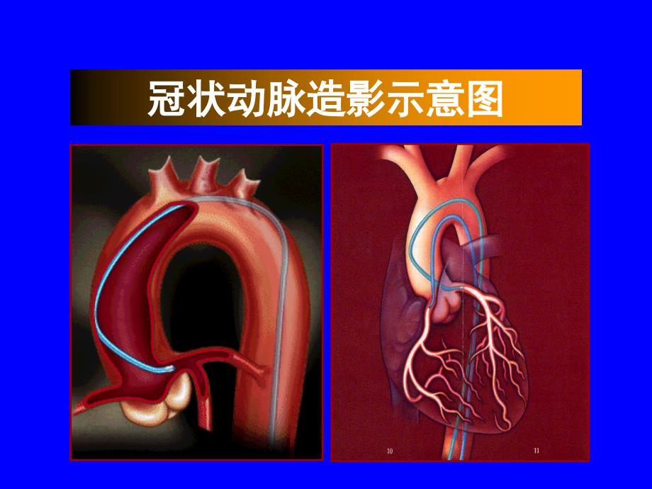 心血管疾病介入治疗_第4页