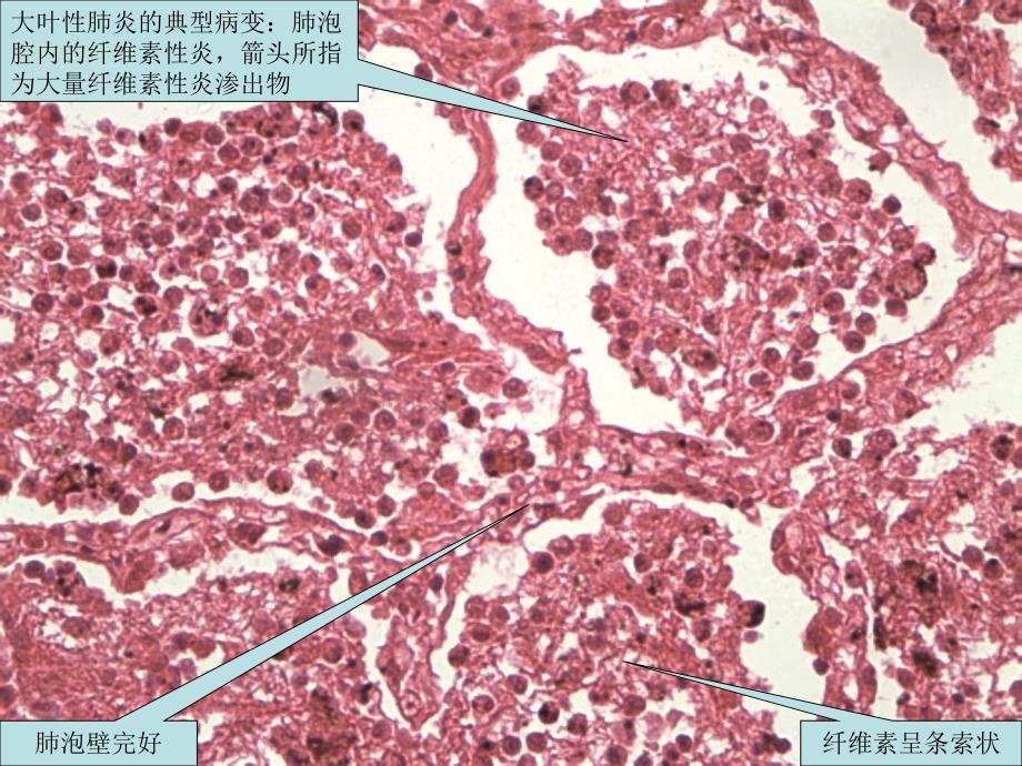 呼吸系统疾病示范教学幻灯片_第2页