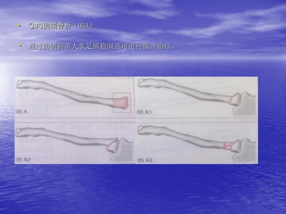 骨折与脱位-诊断分型及治疗一_第5页