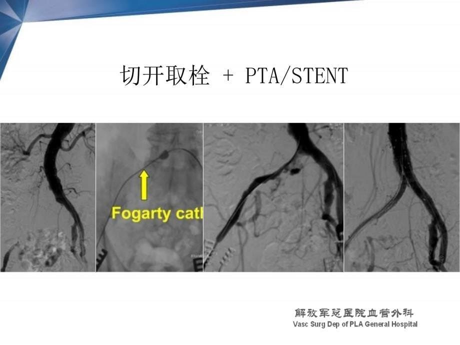 杂交技术在下肢动脉病变中的应用_第5页