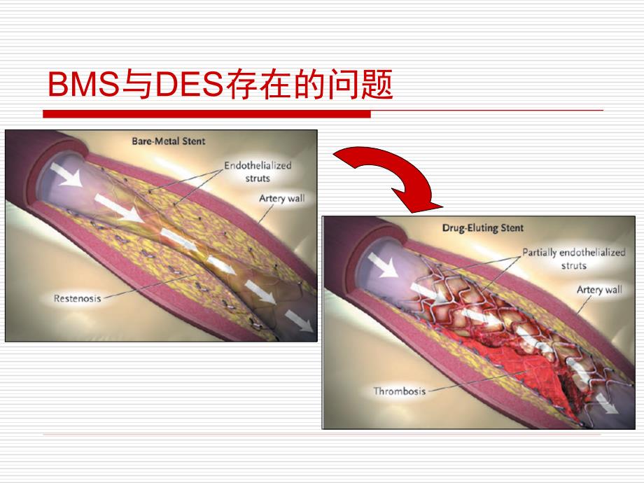 支架内血栓形成的机制与防治_第3页