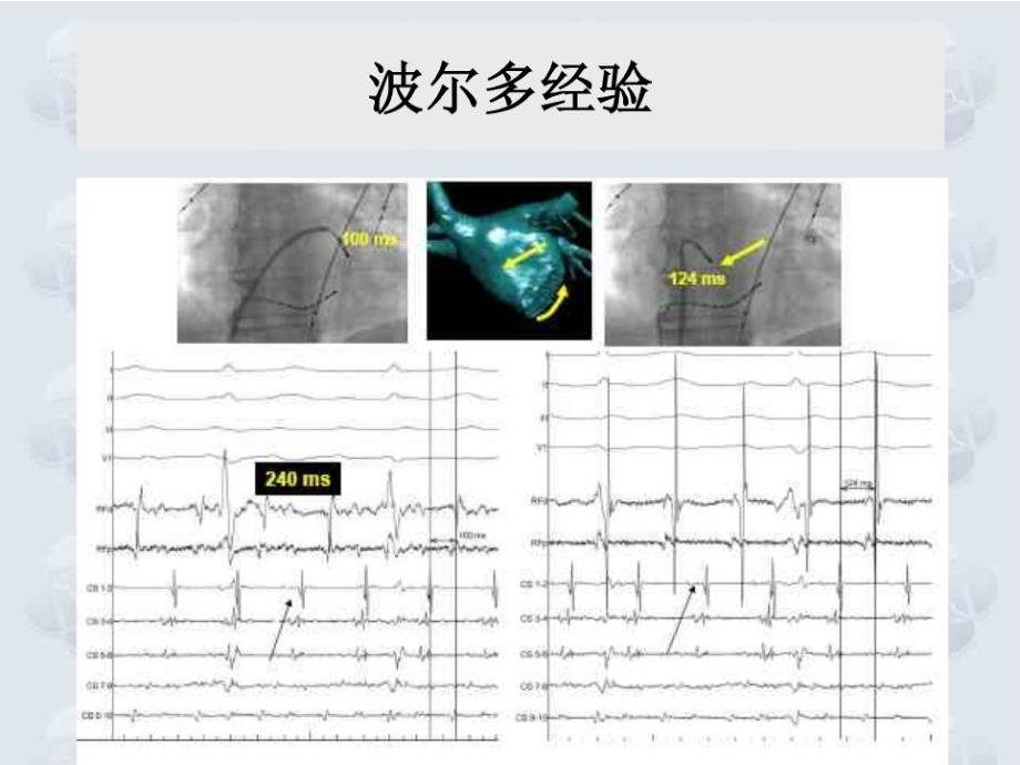 快速诊断和高密度标测在房性心动过速消融中的应用-南京医科大学第一附属医院_第4页