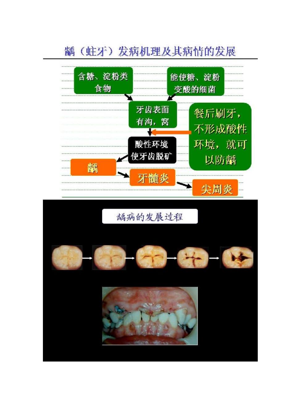 龋(蛀牙)的发生机理、病情发展及有效预防龋齿的三大措施  文档_第2页