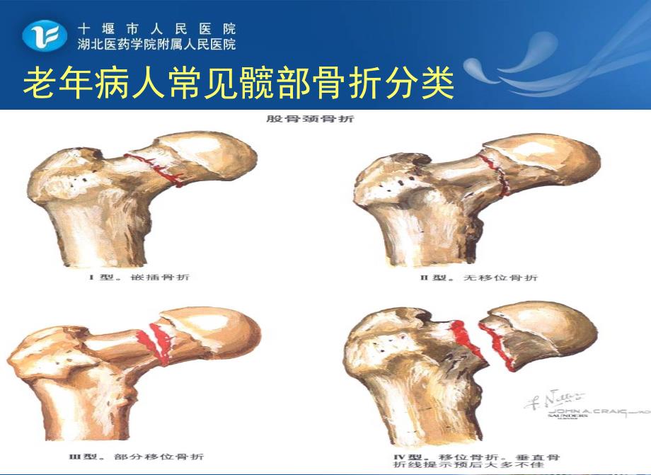 2老年髋部骨折患者的护理(ppt)_第3页