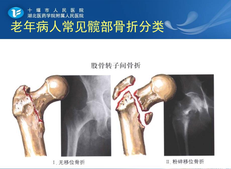 2老年髋部骨折患者的护理(ppt)_第4页