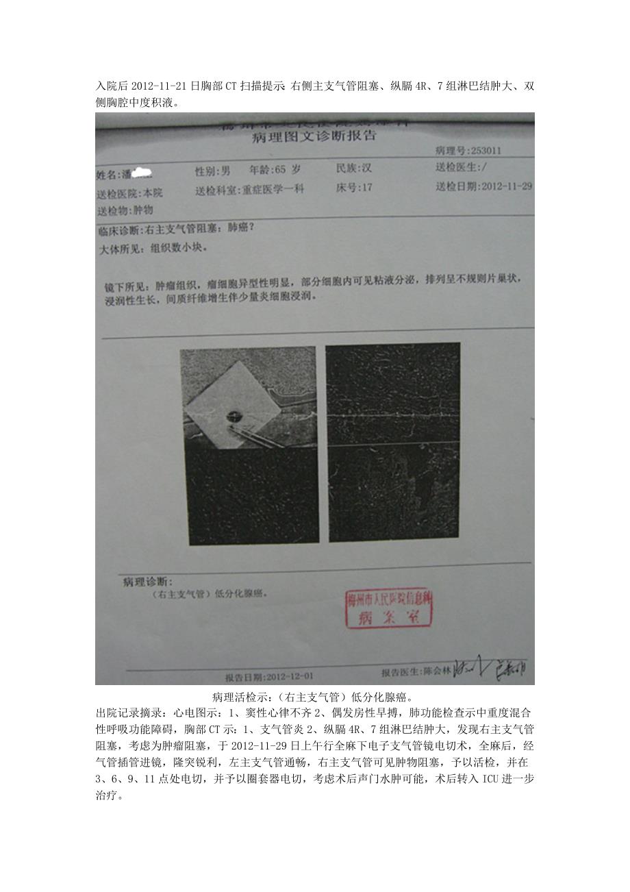 癌性胸腔积液临床案例2_第2页